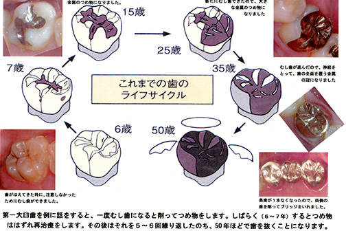 歯の寿命が短くなる本当の理由は何か？
