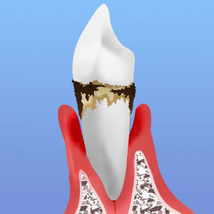 歯周病重度期